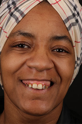 Before and after smile transformation by Advanced Dental Implant and TMJ Center in Southaven, MS.